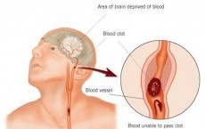 Mini Stroke Ups Risk of Post Traumatic Stress Disorder, Study Finds